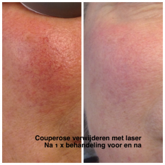 Couperose_1.png